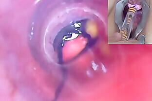 Reife Frau Peehole Endoskop Kamera in Blase mit Eiern